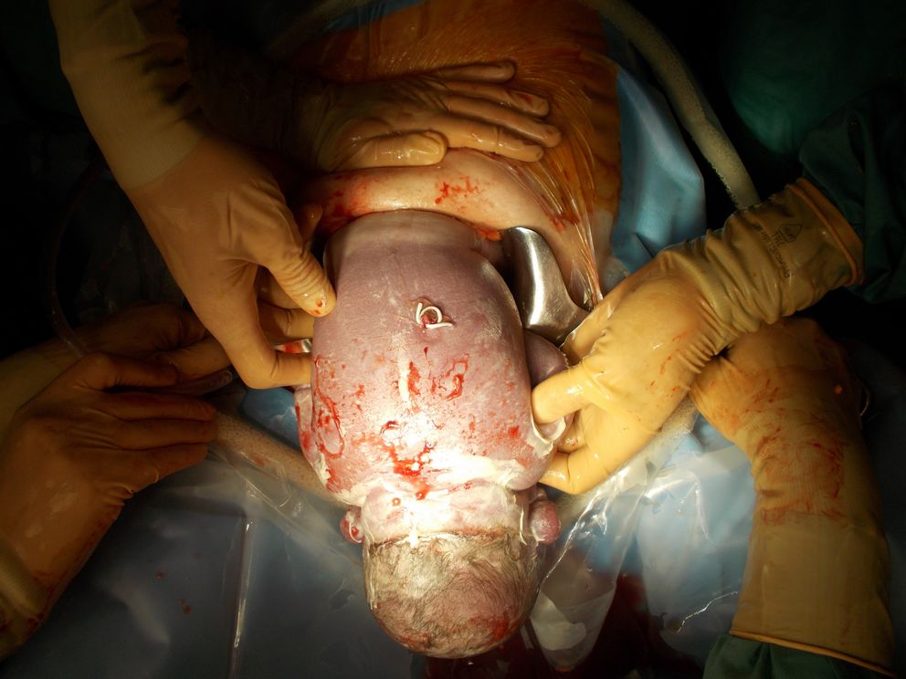 Hydrothorax und Shunt-Implantation